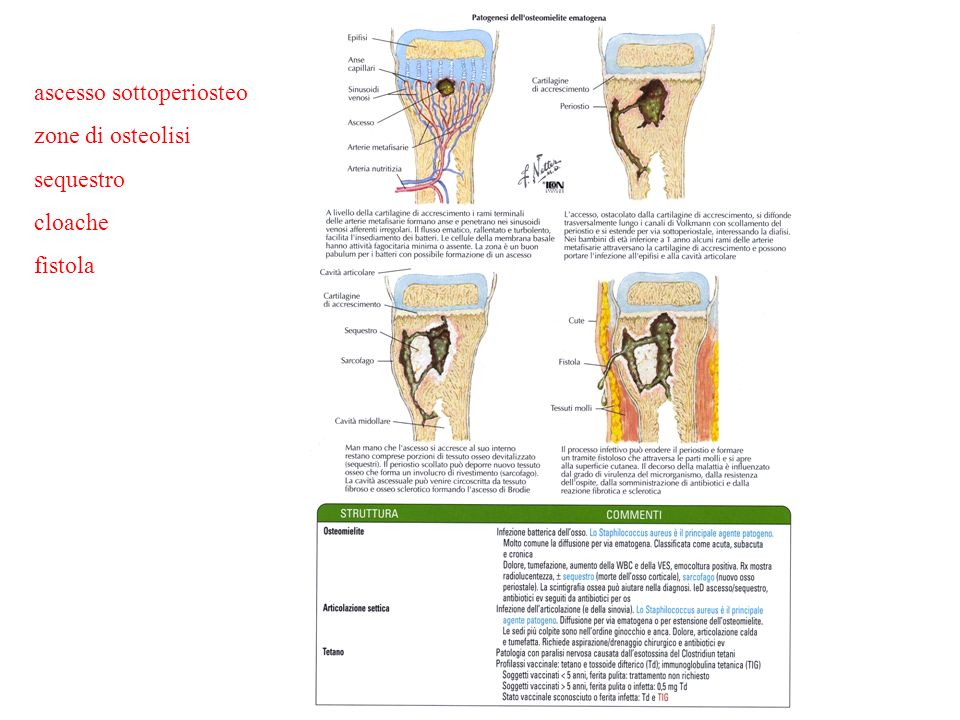 ALTERAZIONI INFIAMMATORIE OSSEE OSTEOMIELITE ppt scaricare